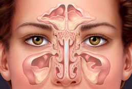 Sinusite et Chirurgie Endoscopique des Sinus