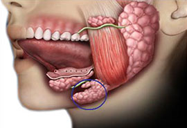 Salivary Gland Surgery