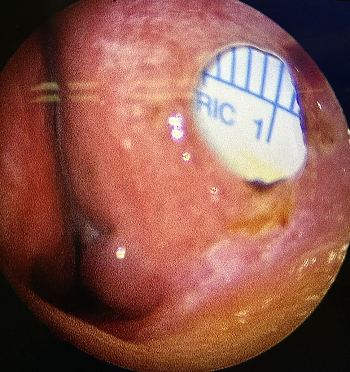 Septum perforasyonu tamiri kapalı teknik ile yapılabilir mi? 